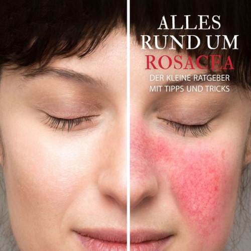 Raphael Kleine-Termeer - Alles Rund um Rosacea - Der kleine Ratgeber mit Tipps und Tricks