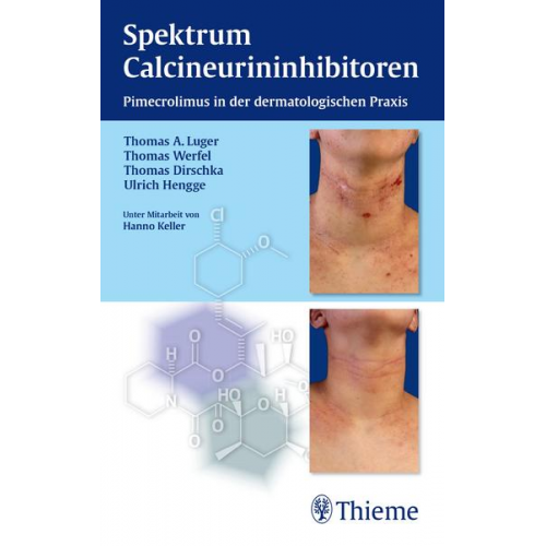 Thomas A. Luger & Thomas Dirschka & Ulrich R. Hengge - Spektrum Calcineurininhibitoren: Pimecrolimus in der dermatologischen Praxis