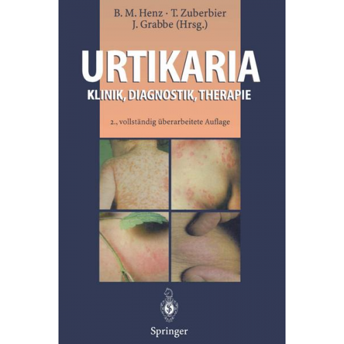 Urtikaria