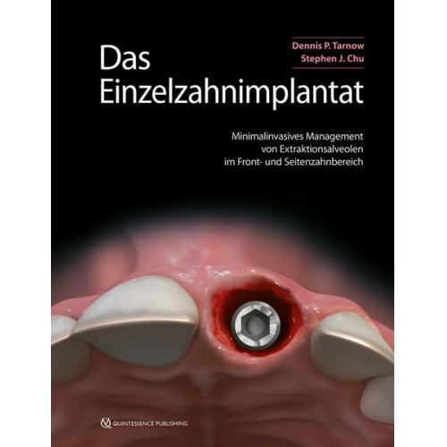 Dennis P. Tarnow & Stephen J. Chu - Das Einzelzahnimplantat