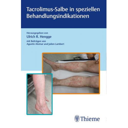 Tacrolimus-Salbe in speziellen Behandlungsindikationen