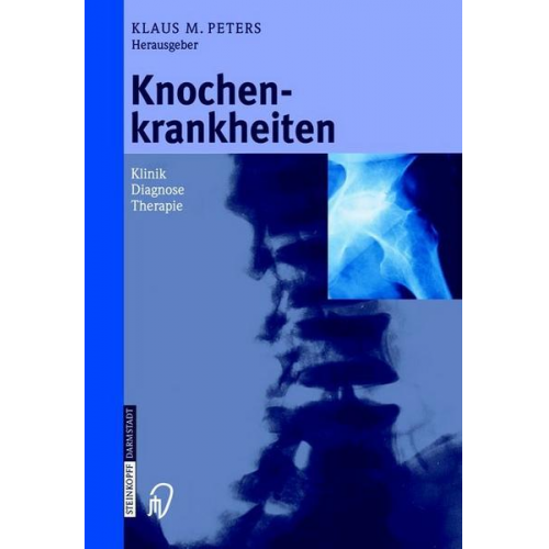 Knochenkrankheiten