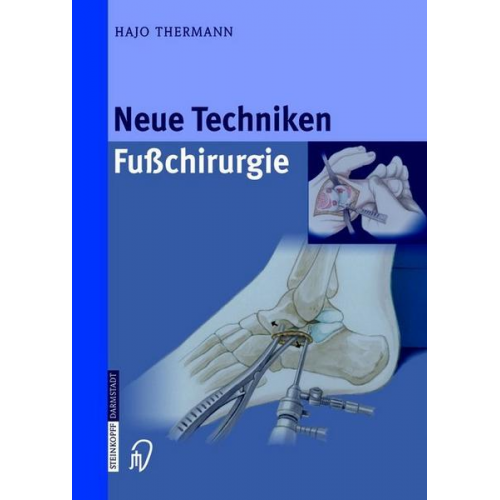 Hajo Thermann - Neue Techniken Fusschirurgie