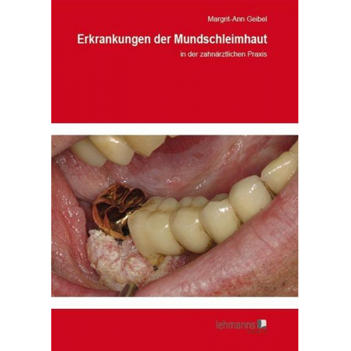 Margrit-Ann Geibel - Erkrankungen der Mundschleimhaut