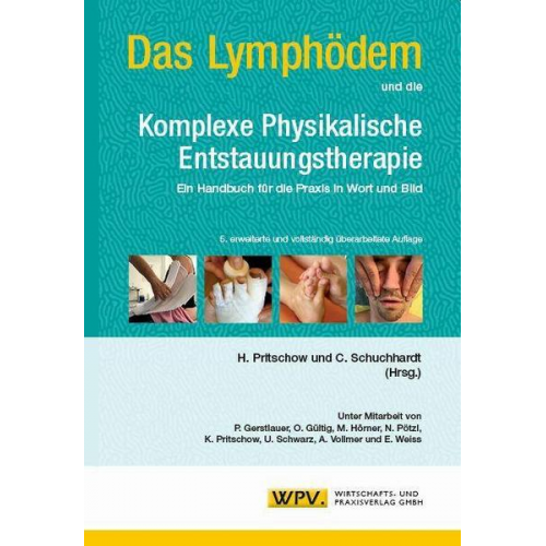 Das Lymphödem und die Komplexe Physikalische Entstauungstherapie