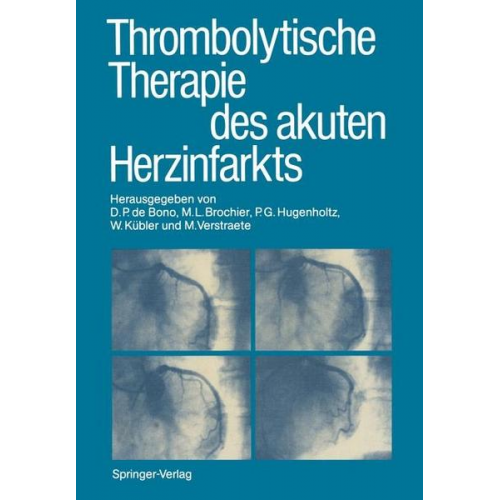 Thrombolytische Therapie des akuten Herzinfarkts