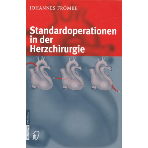 Johannes Frömke - Standardoperationen in der Herzchirurgie