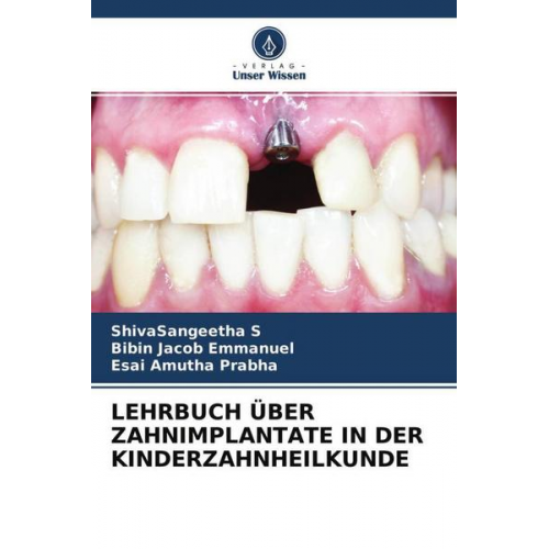 ShivaSangeetha S. & Bibin Jacob Emmanuel & Esai Amutha Prabha - Lehrbuch über Zahnimplantate in der Kinderzahnheilkunde