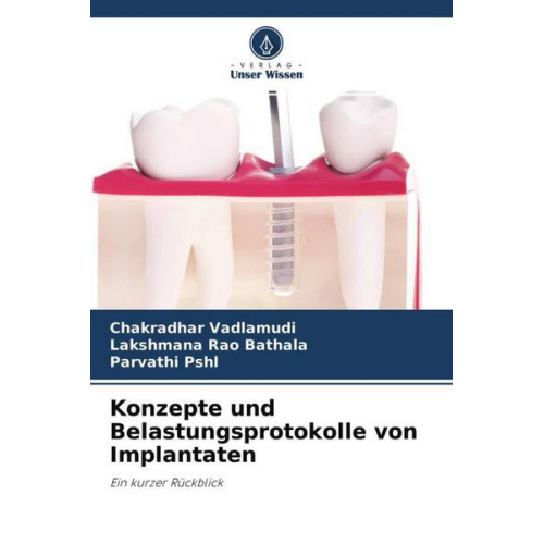 Chakradhar Vadlamudi & Lakshmana Rao Bathala & Parvathi PSHL - Konzepte und Belastungsprotokolle von Implantaten