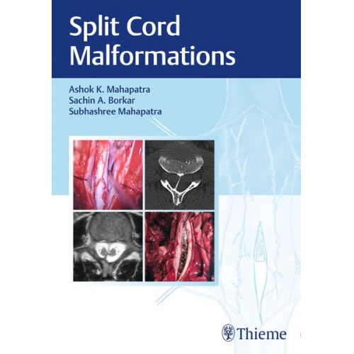 Ashok Mahapatra Sachin Borkar Subhashree Mahapatra - Split Cord Malformations