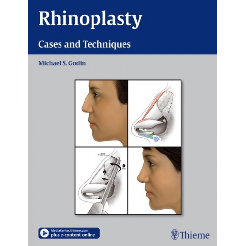 Michael S. Godin - Rhinoplasty - Cases and Techniques